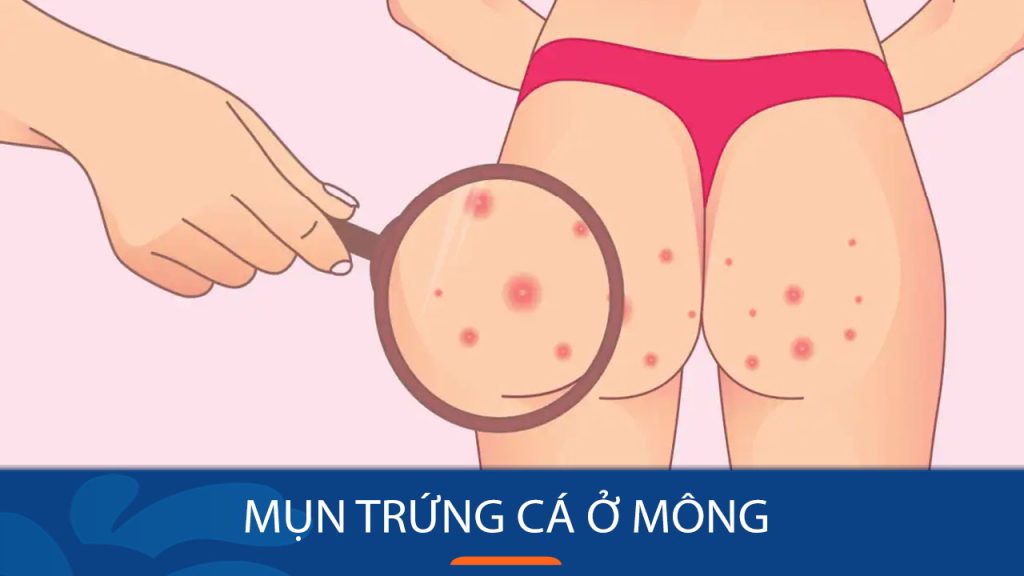Mụn trứng cá ở mông: Bí quyết đánh bay mụn trứng cá ở mông chỉ trong 7 ngày