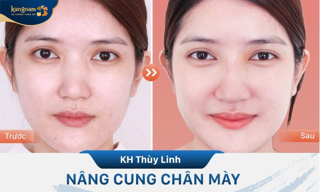 Nâng chân mày giúp trẻ hóa gương mặt