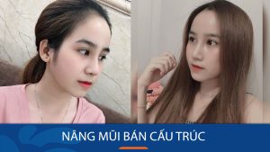 Nâng mũi bán cấu trúc: Bí quyết sở hữu dáng mũi đẹp tự nhiên