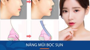 Nâng mũi bọc sụn: Bí quyết sở hữu dáng mũi đẹp hoàn hảo