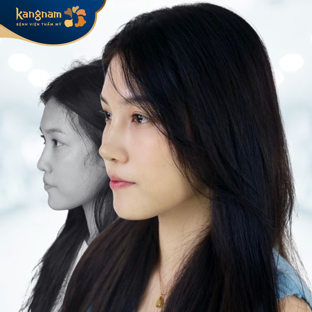 Hải Ngọc nâng mũi tại Kangnam nhiều năm, chăm sóc tốt nên dáng mũi ổn định cân đối