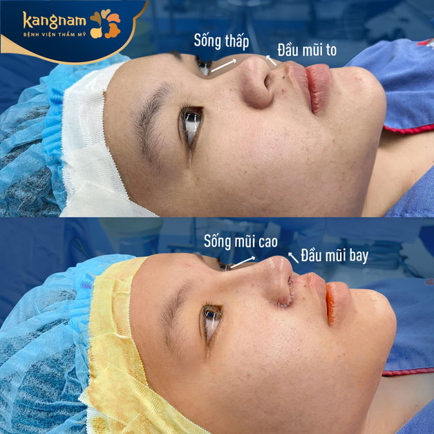 Quá trình tạo hình mũi tại Kangnam diễn ra nhẹ nhàng, không đau đớn