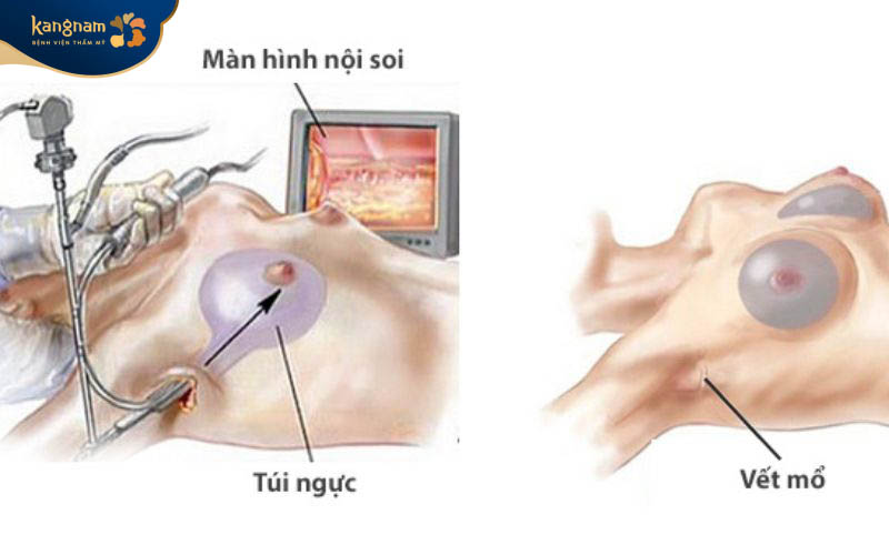 Phương pháp nâng ngực nội soi sử dụng thiết bị nội soi để hỗ trợ đưa túi độn vào khoang ngực