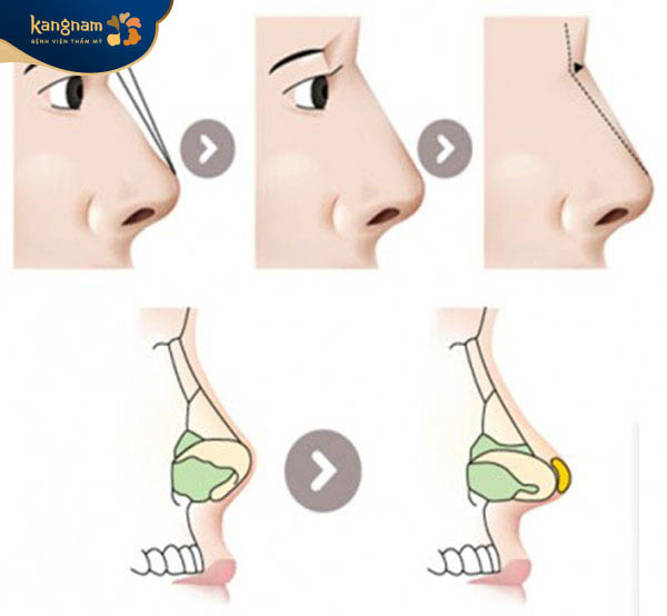 Nâng mũi bán cấu trúc phù hợp với những dáng mũi ít khuyết điểm