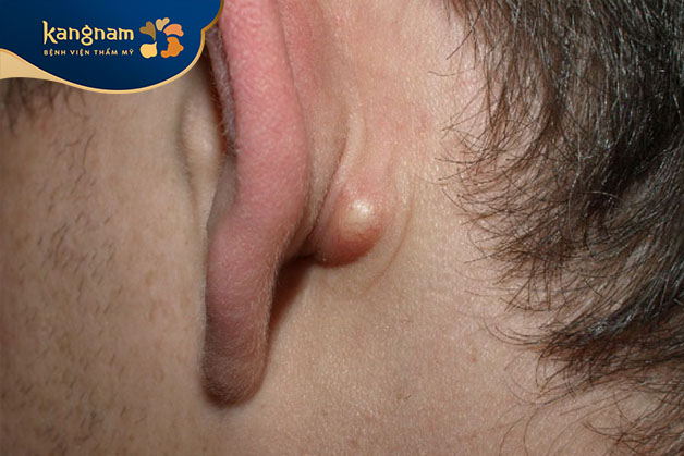 Nhiễm trùng tai có thể khiến ống tai viêm nhiễm, gây mụn mủ và đau nhức khó chịu