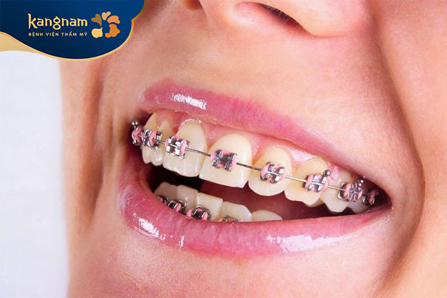 Quá trình niềng răng giúp đưa răng về vị trí chính xác trên cung hàm