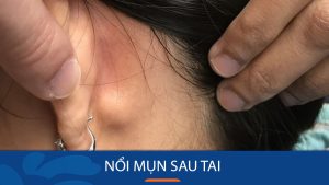 Nổi mụn sau tai là bị gì? Nguyên nhân và cách điều trị hiệu quả