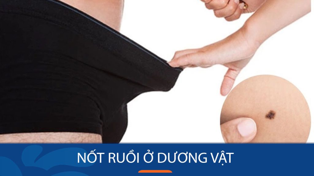 Nốt ruồi ở Dương Vật: Nên lo lắng hay không và cách xử lý hiệu quả?