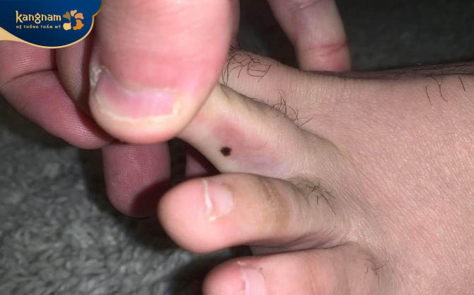 Nốt ruồi xuất hiện ở vị trí ngón chân trỏ lại mang đến ý nghĩa không được tốt