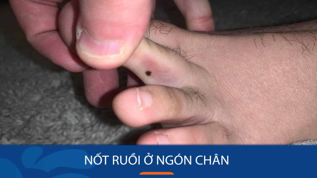 Hé lộ ý nghĩa nốt ruồi ở từng ngón chân: Tốt hay xấu?