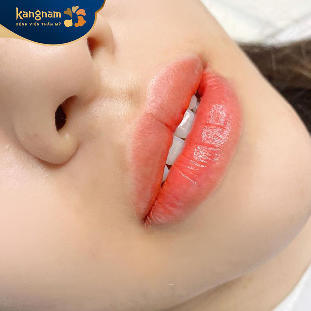 Kangnam có cung cấp dịch vụ khử thâm môi an toàn, hiệu quả