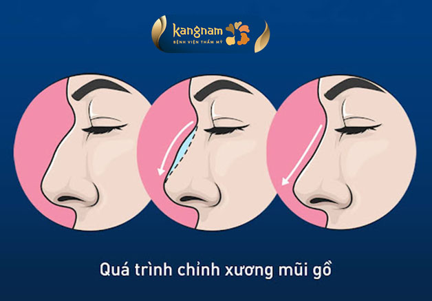 Sửa mũi lệch, gồ sẽ can thiệp để điều chỉnh hình dáng và cấu trúc của mũi