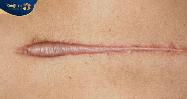Vùng da sau khi lành vết thương tăng sinh collagen quá mức