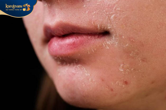 Lột da làm đầy các vùng da bị sẹo lõm trên da mặt