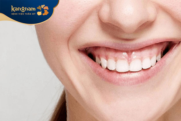 Cười hở lợi là hiện tượng phần nướu ở hàm trên lộ ra quá nhiều khi cười