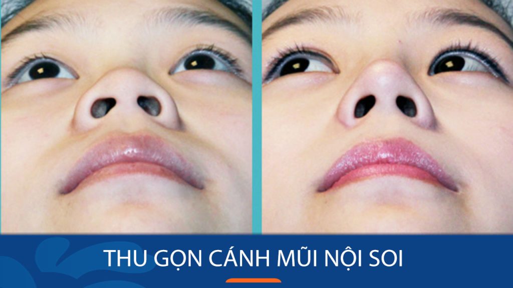 Thu gọn cánh mũi nội soi – Tạo hình mũi thon gọn, cân đối