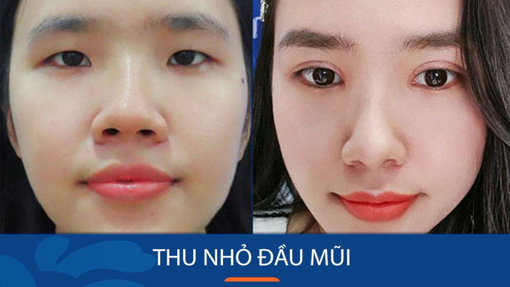 Bí quyết thu nhỏ đầu mũi hiệu quả và an toàn