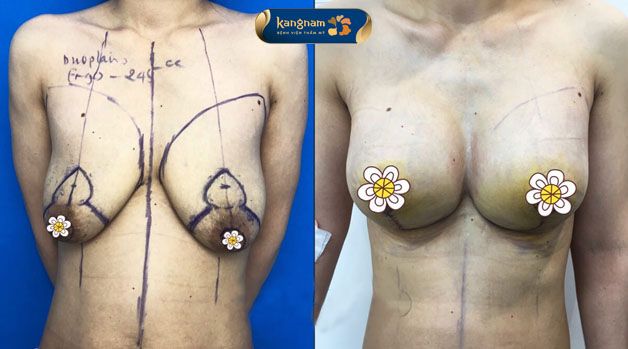 Phương pháp treo sa trễ ngực có đặt túi giúp bầu ngực có hình dáng cân đối
