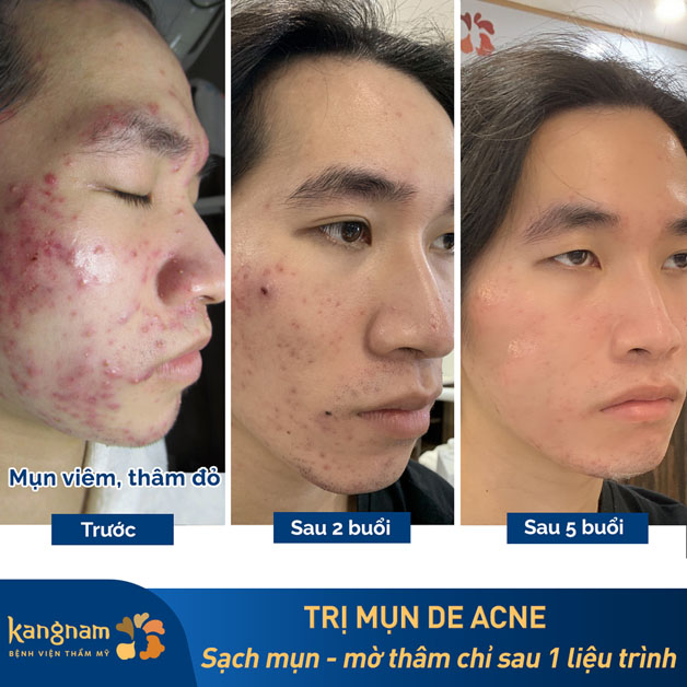 Kangnam cung cấp công nghệ trị mụn De-Acne được FDA chứng nhận an toàn và hiệu quả