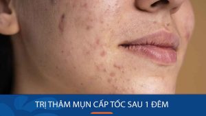 Cách trị thâm mụn cấp tốc sau 1 đêm nhanh chóng, an toàn