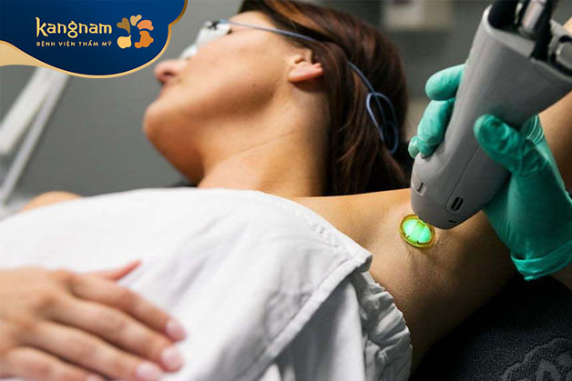 Kỹ thuật điều trị bằng tia laser giúp loại bỏ và giảm thiểu tiết mồ hôi vùng nách