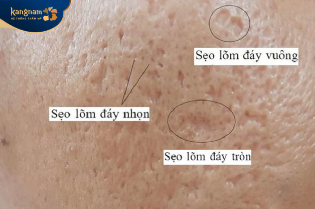 Các loại sẹo rỗ phổ biến trên da