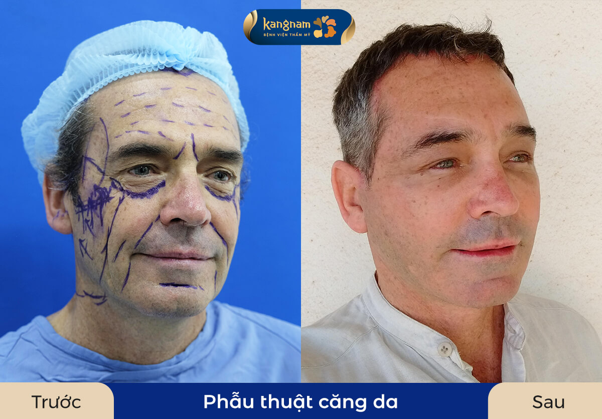 Hình ảnh khách hàng sau khi phẫu thuật căng da tại Kangnam