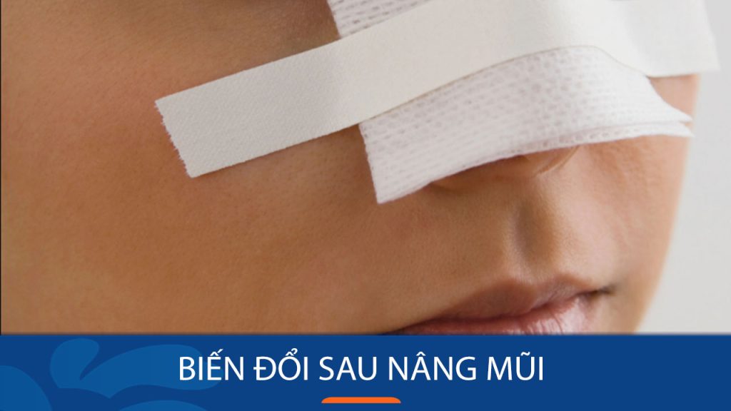 Những biến đổi không mong muốn sau nâng mũi, bạn cần biết