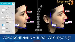 Công nghệ Nâng mũi Idol có gì đặc biệt? Bác sĩ kangnam giải đáp