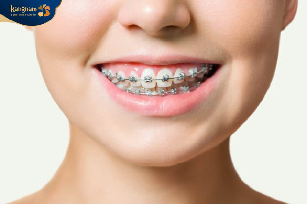 Niềng răng cũng là cách cải thiện dáng môi, nụ cười