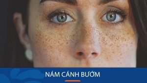 Nám cánh bướm là gì? Nguyên nhân, cách điều trị và phòng tránh