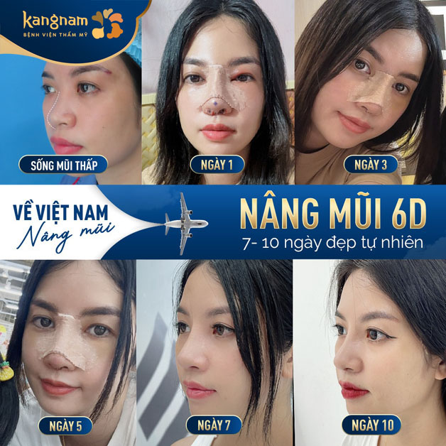 Nâng mũi 6D mang lại kết quả tự nhiên và hài hòa với từng đường nét