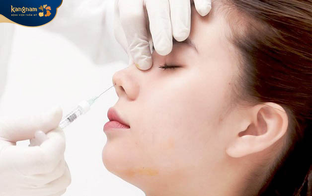Tiêm filler là phương pháp đưa chất làm đầy HA vào vùng dưới da ở sống mũi.