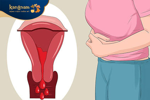 Viêm cổ tử cung gây ngứa âm đạo