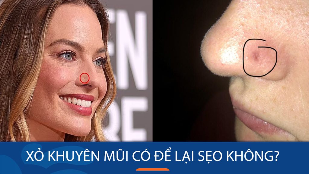 Xỏ khuyên mũi có để lại sẹo không? Lưu ý khi xỏ khuyên mũi