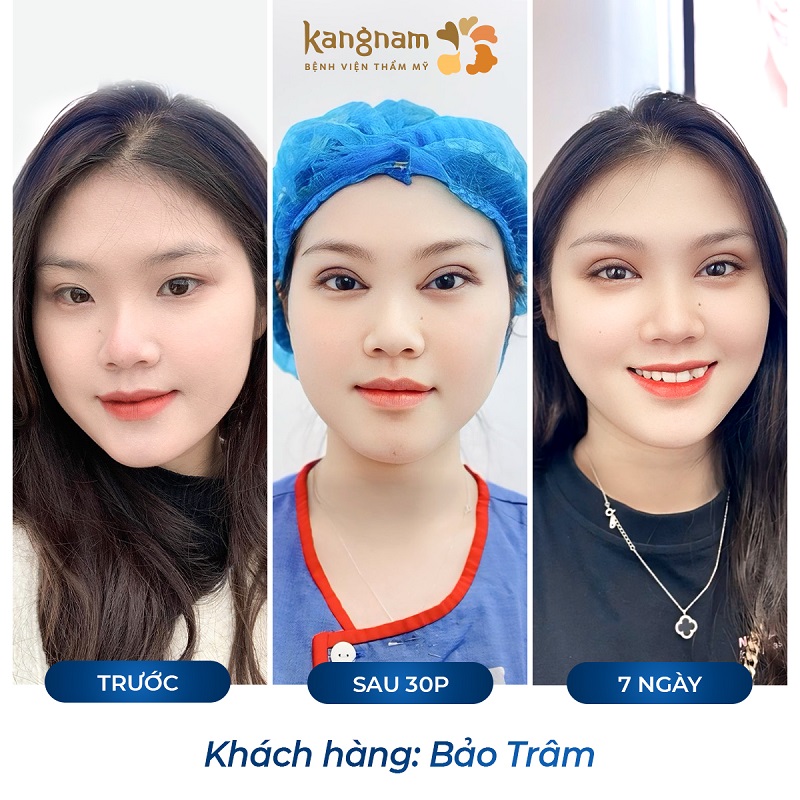 Sau 7 ngày mí mắt vào form, đẹp tự nhiên