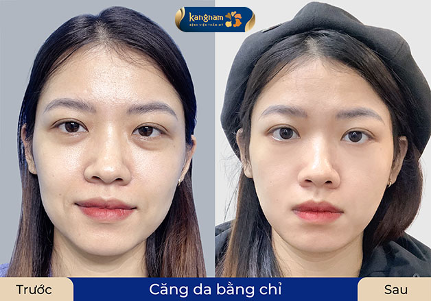 Khách hàng Kangnam trước và sau khi căng chỉ da