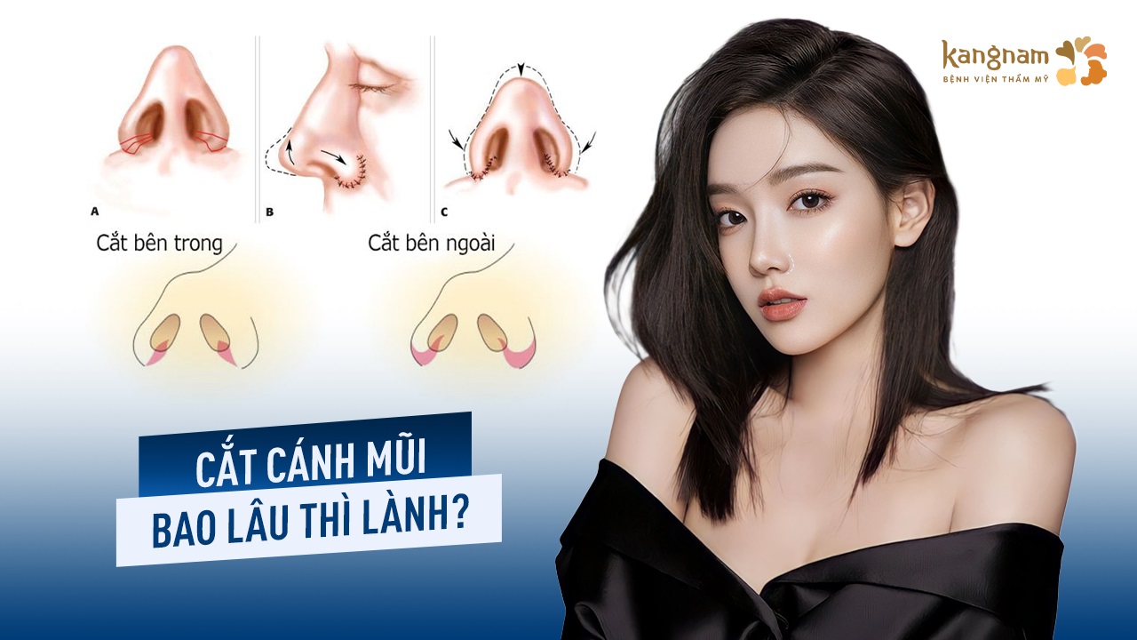 Cắt cánh mũi bao lâu thì lành? các mốc thời gian quan trọng