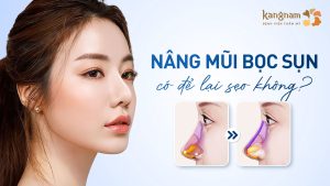 Nâng Mũi Bọc Sụn Có Để Lại Sẹo? Giải Đáp Từ Chuyên Gia & Kinh Nghiệm Thực Tế