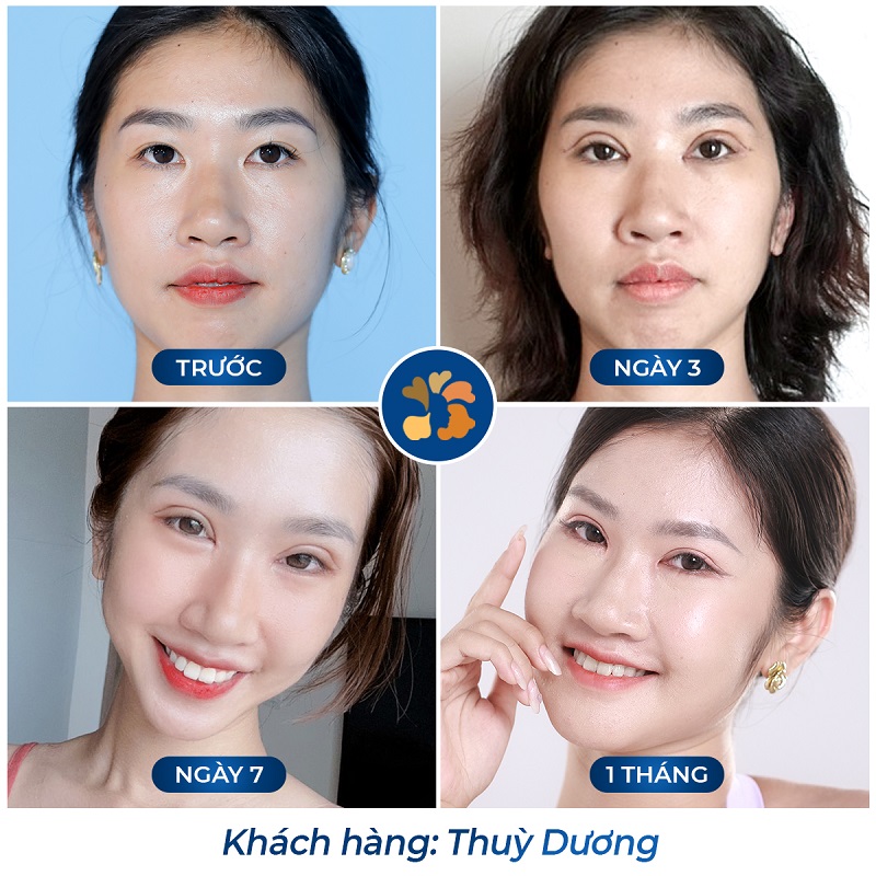Sau 1 tháng mí mắt đã ổn định, vào nếp