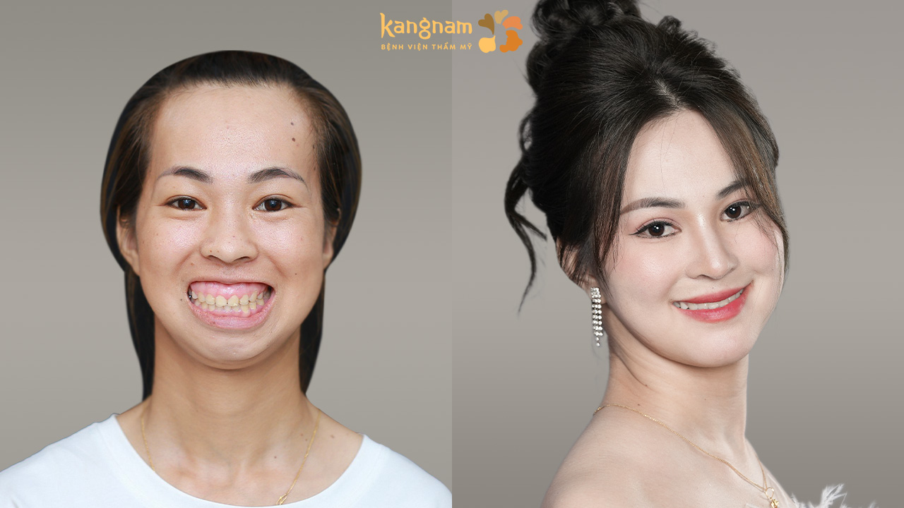 Thí sinh HTLX trước và sau khi chỉnh hàm hô