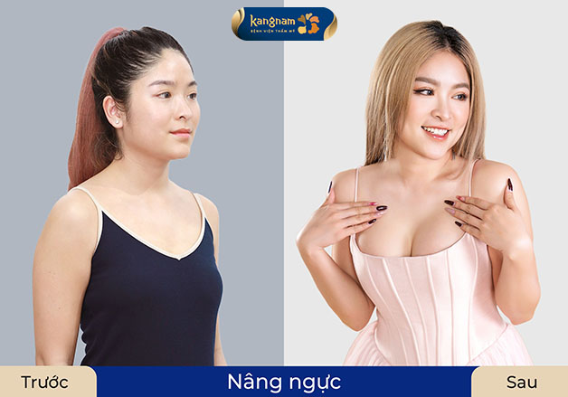 Khách hàng trước và sau khi nâng ngực tại Kangnam, trở nên quyến rũ hơn
