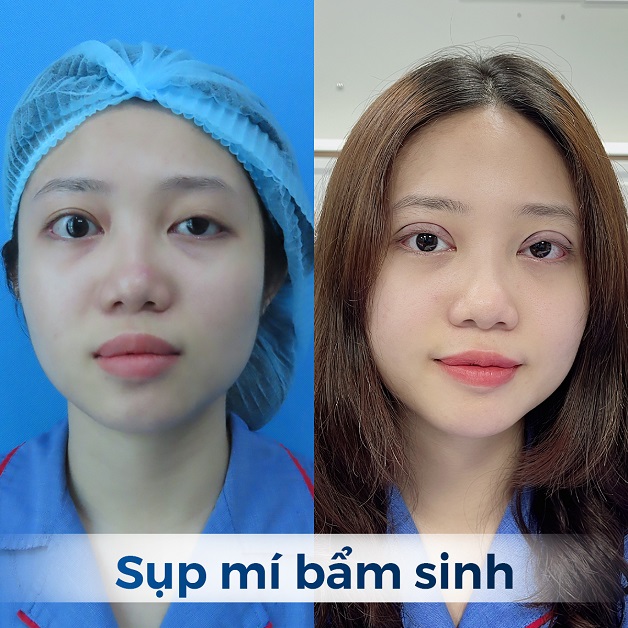 T.K.A bị sụp mí bẩm sinh, sau cắt mí đôi bắt to tròn, rõ nét