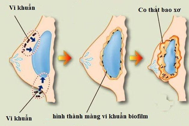 Ngực luôn trong trạng thái căng tức, khó chịu