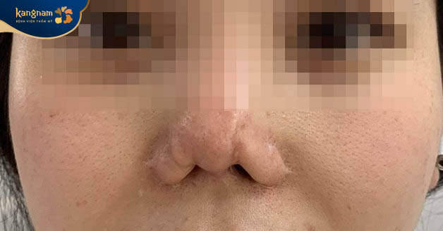 Mũi bị biến dạng khi nâng mũi kém chất lượng
