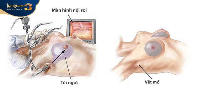 Nâng ngực nội soi có gắn camera giúp bác sĩ có thể quan sát chi tiết cấu trúc khoang ngực trên màn hình