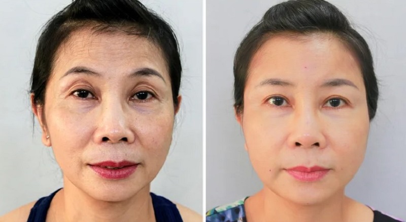 Phương pháp cấy mỡ giúp khắc phục thâm quầng mắt