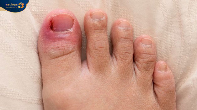 Sưng mủ khóe chân có nguy hiểm nếu bị nhiễm trùng