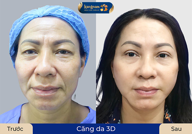 Da căng mịn, trẻ trung sau khi căng da 3D tại Kangnam