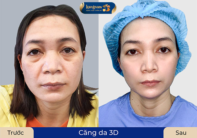 Căng da 3D giúp gương mặt căng bóng, trẻ trung